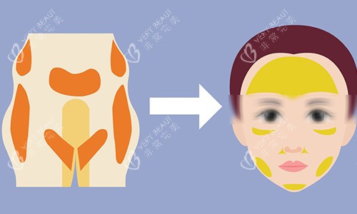 脂肪填充动画图 脂肪填充动画图