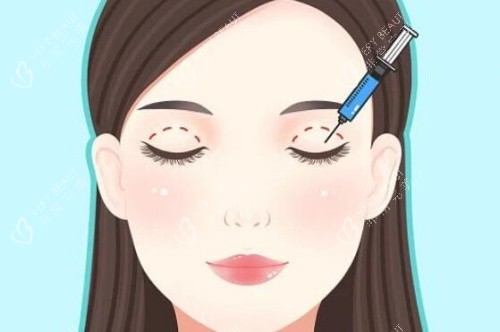 做双眼皮示意图 做双眼皮示意图