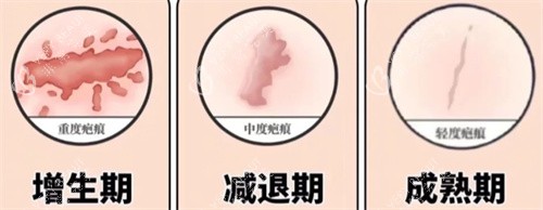 开眼角术后疤痕期 开眼角术后疤痕期