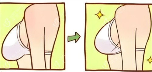 乳房下垂内衣穿着对比