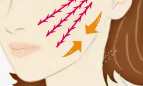 拉皮手术的大致流程示意图