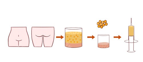 脸部脂肪填充图 脸部脂肪填充图