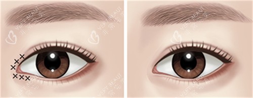 开眼角手术前后对比图 开眼角手术前后对比图