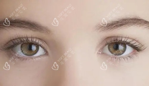 开眼角手术.webp 开眼角手术.webp