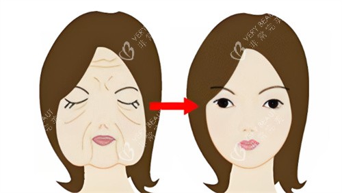 面部抗衰前后对比 面部抗衰前后对比