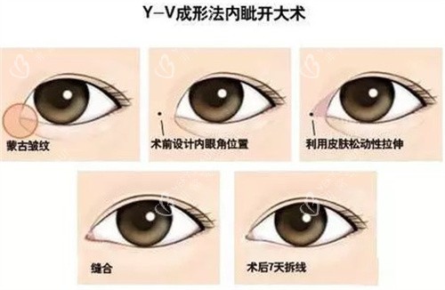 开眼角Y-V成型法 开眼角Y-V成型法