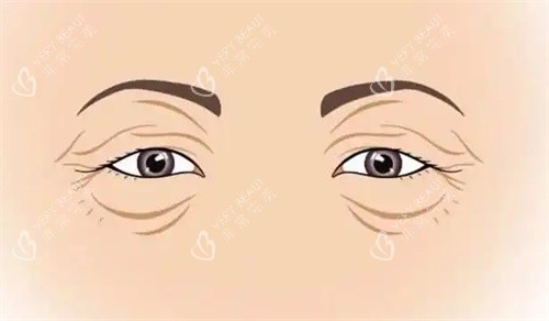 衰老的双眼皮 衰老的双眼皮