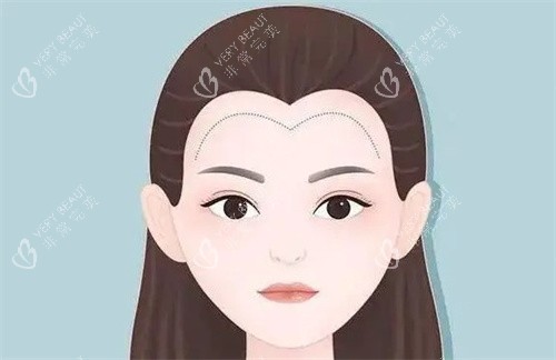 植发际线卡通 植发际线卡通