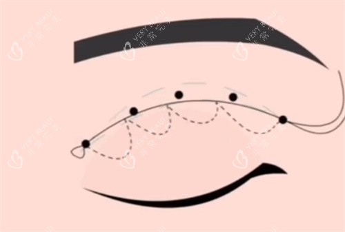 埋线双眼皮 埋线双眼皮