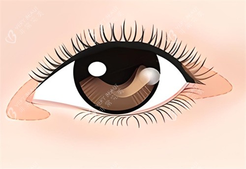 开眼角术宣传图 开眼角术宣传图
