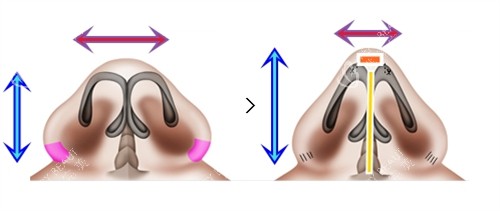 鼻翼缩小加隆鼻手术对比 鼻翼缩小加隆鼻手术对比