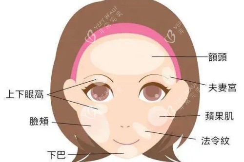 面部可以脂肪填充的部位卡通图 面部可以脂肪填充的部位卡通图