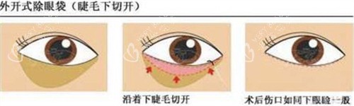 外切法祛眼袋手术步骤