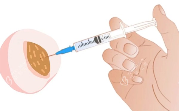 私密注射紧缩针照片 私密注射紧缩针照片