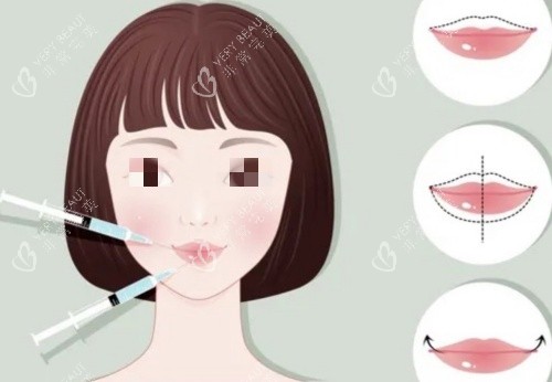 丰唇注射前后示意图 丰唇注射前后示意图