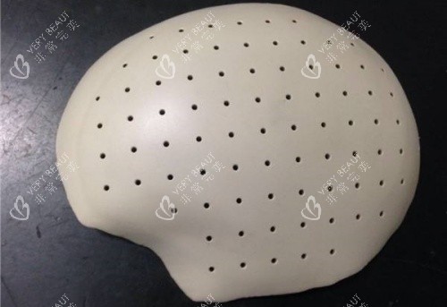 PEEK材料填充颅骨示意图