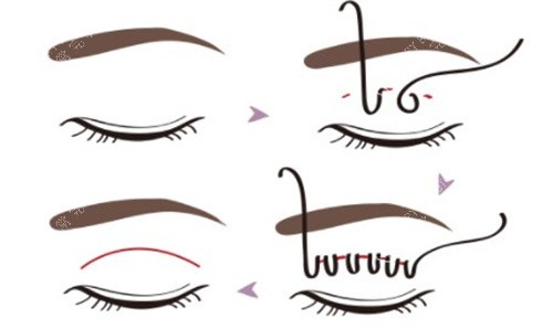 VLINE双眼皮手术 VLINE双眼皮手术