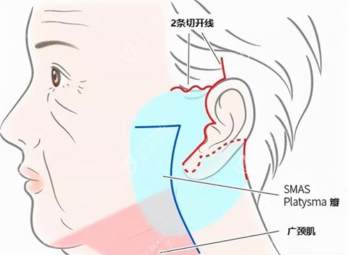 面部拉皮手术 面部拉皮手术