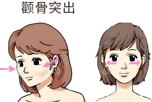 颧骨突出动画演示图 颧骨突出动画演示图