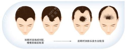 脱发步骤动画演示图 脱发步骤动画演示图