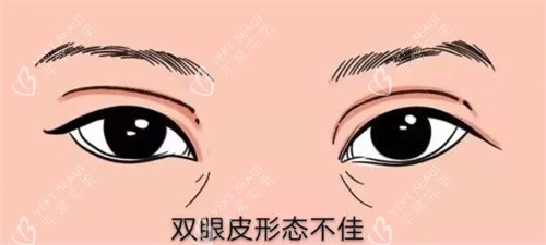 双眼皮修复示图 双眼皮修复示图