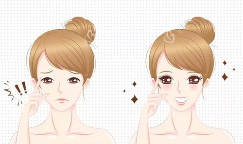 双眼皮术宣传图