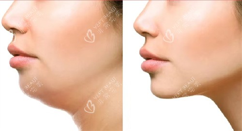 双下巴吸脂