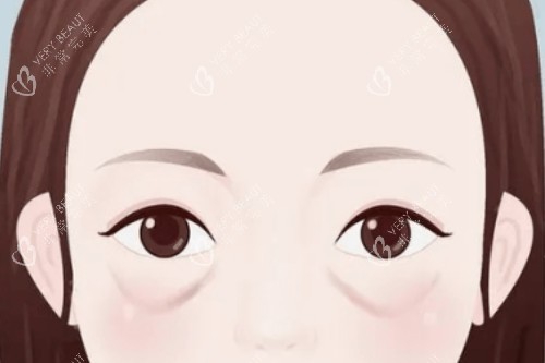 眼袋卡通展示图 眼袋卡通展示图