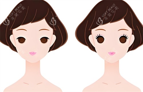 双眼皮前后对比图 双眼皮前后对比图