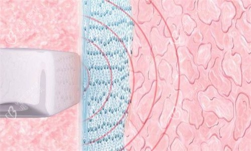 阴道紧缩原理 阴道紧缩原理