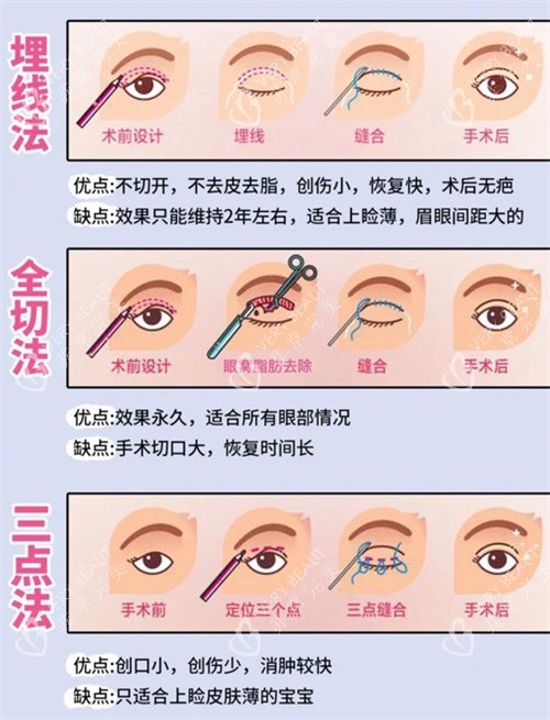 双眼皮三种手术方式动画