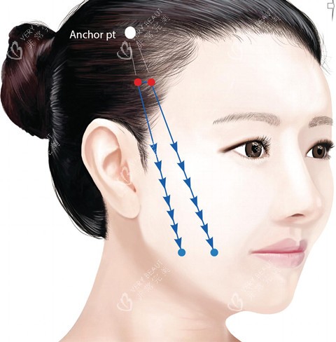 面部线提升卡通图 面部线提升卡通图