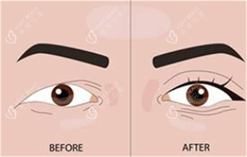 双眼皮手术前后对比