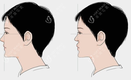 鼻基底填充前后对比卡通示意图 鼻基底填充前后对比卡通示意图