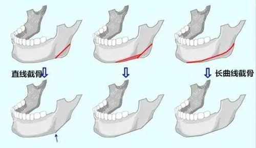下颌骨截骨整形卡通示意图 下颌骨截骨整形卡通示意图
