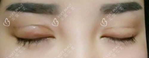 双眼皮失败照片 双眼皮失败照片