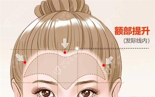 额部提升所定位切口的位置 额部提升所定位切口的位置