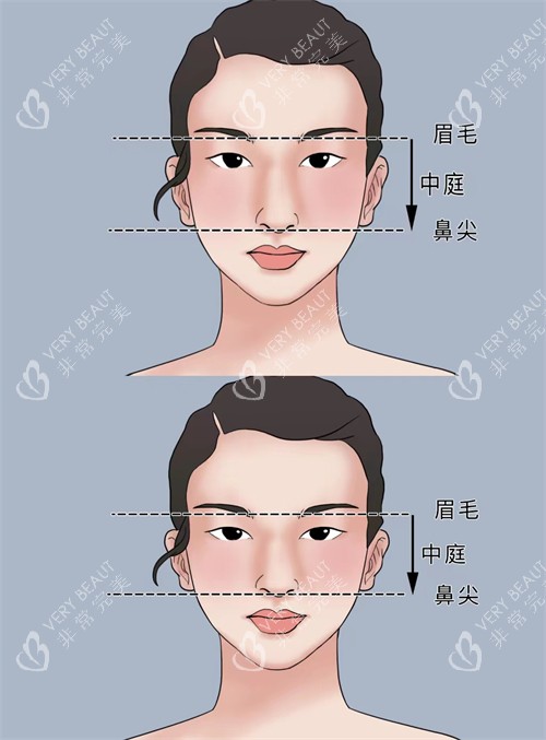 正常鼻子和过长鼻子矫正对比