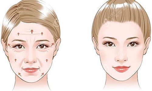 拉皮手术前后对比图 拉皮手术前后对比图