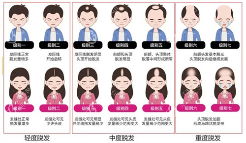 不同程度的脂溢性脱发 不同程度的脂溢性脱发