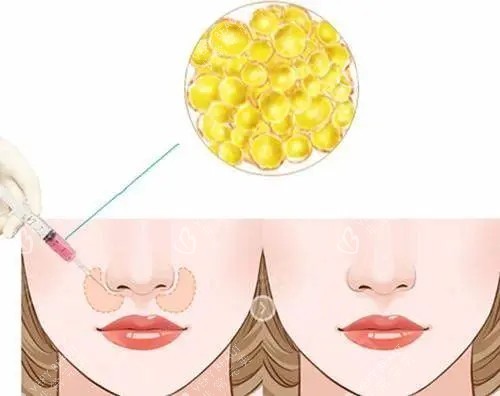 脂肪填充鼻基底位置示意图 脂肪填充鼻基底位置示意图