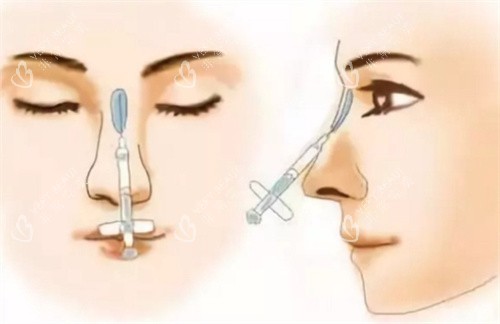 隆鼻材料注射 隆鼻材料注射