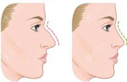 驼峰鼻矫正手术 驼峰鼻矫正手术