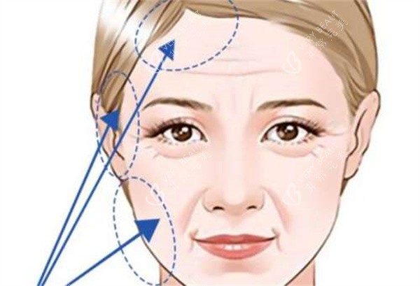 拉皮整形手术 拉皮整形手术