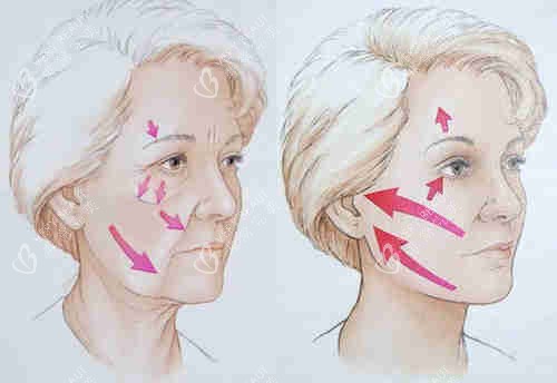 面部提升图示 面部提升图示