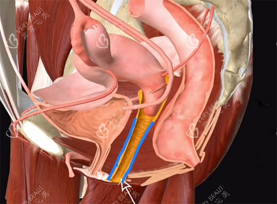 阴道紧缩针动画原理 阴道紧缩针动画原理
