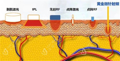 黄金微针射频层次