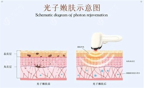 光子嫩肤 光子嫩肤
