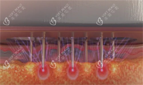 黑曜双波黄金微针怎么样 黑曜双波黄金微针怎么样
