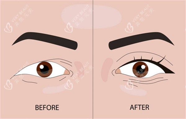 埋线双眼皮整形 埋线双眼皮整形